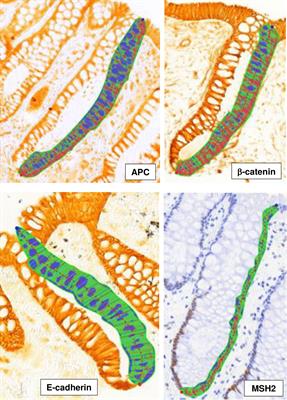 Associations of dietary, lifestyle, and other participant characteristics with APC, β-catenin, E-cadherin, and MSH2 expression in the normal mucosa of sporadic colorectal adenoma patients